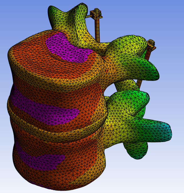 EMAE 415 - Spinal Fusion FEA Study